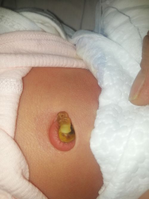 榆阳区妇幼保健院产房新技术 新生儿无包扎脐部护理与脐带护理液的创新应用